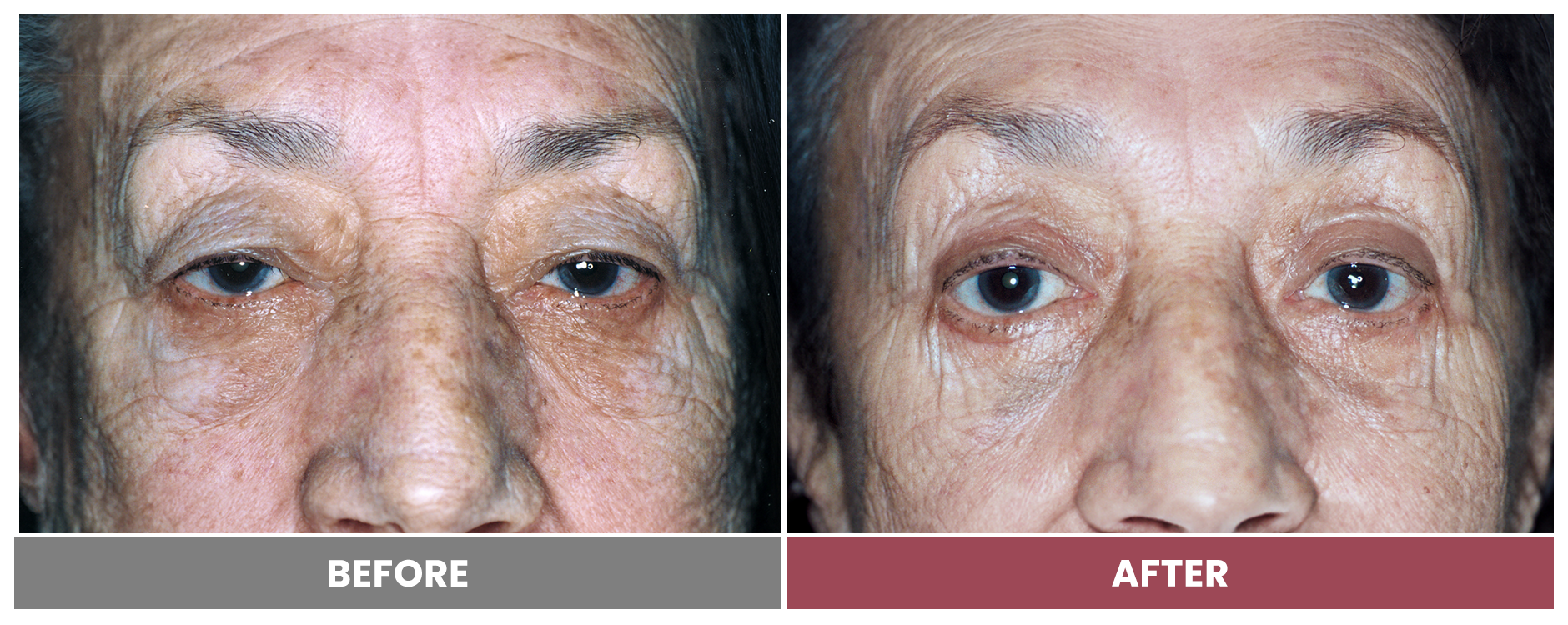 PTOSIS REPAIR - Case 26